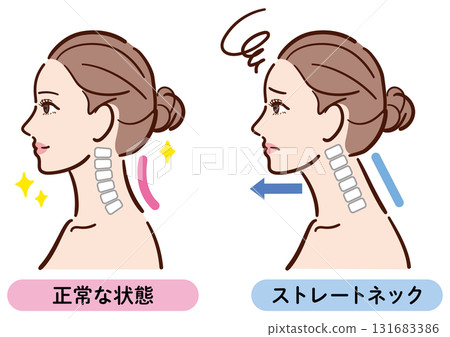 Illustration comparing normal and straight neck (female profile) 131683386