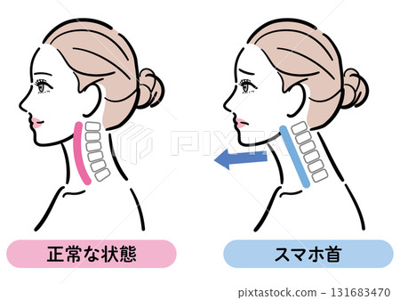 正確姿勢與智慧型手機頸部的比較圖(女性側面) 正確姿勢與智慧型手機頸部的比較圖(女性側面) 131683470