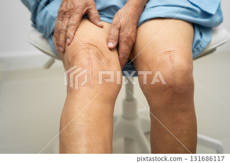 Asian elderly woman patient with scar knee replacement surgery in hospital. 131686117
