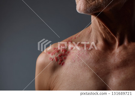 Skin condition affects older man's shoulder with red spots in close-up view during indoor session 131689721