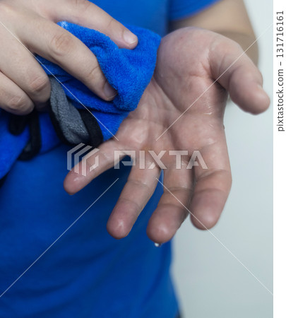 A man suffers from palmar hyperhidrosis. He wipes his sweaty palms due to excessive sweating. Treatment of hyperhidrosis with botulinum toxin injection into the hand. A man suffers from palmar hyperhidrosis. He wipes his sweaty palms due to excessive sweating. Treatment of hyperhidrosis with botulinum toxin injection into the hand. 131716161