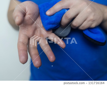 A man suffers from palmar hyperhidrosis. He wipes his sweaty palms due to excessive sweating. Treatment of hyperhidrosis with botulinum toxin injection into the hand. A man suffers from palmar hyperhidrosis. He wipes his sweaty palms due to excessive sweating. Treatment of hyperhidrosis with botulinum toxin injection into the hand. 131716164