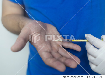 A man suffers from palmar hyperhidrosis. He wipes his sweaty palms due to excessive sweating. Treatment of hyperhidrosis with botulinum toxin injection into the hand. A man suffers from palmar hyperhidrosis. He wipes his sweaty palms due to excessive sweating. Treatment of hyperhidrosis with botulinum toxin injection into the hand. 131716171