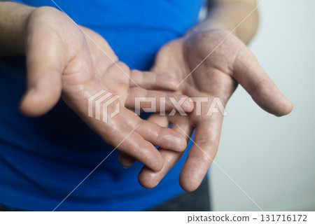 A man suffers from palmar hyperhidrosis. He wipes his sweaty palms due to excessive sweating. Treatment of hyperhidrosis with botulinum toxin injection into the hand. 131716172