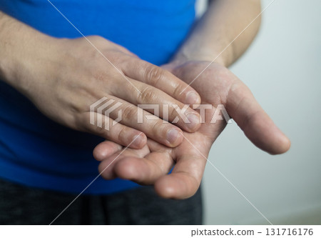 A man suffers from palmar hyperhidrosis. He wipes his sweaty palms due to excessive sweating. Treatment of hyperhidrosis with botulinum toxin injection into the hand. A man suffers from palmar hyperhidrosis. He wipes his sweaty palms due to excessive sweating. Treatment of hyperhidrosis with botulinum toxin injection into the hand. 131716176
