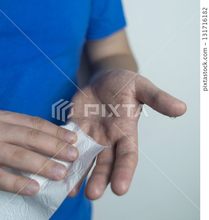 A man suffers from palmar hyperhidrosis. He wipes his sweaty palms due to excessive sweating. Treatment of hyperhidrosis with botulinum toxin injection into the hand. A man suffers from palmar hyperhidrosis. He wipes his sweaty palms due to excessive sweating. Treatment of hyperhidrosis with botulinum toxin injection into the hand. 131716182