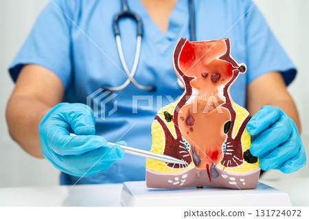 Asian doctor with rectum and hemorrhoid human anatomy model at hospital, inflamed vascular structure. Asian doctor with rectum and hemorrhoid human anatomy model at hospital, inflamed vascular structure. 131724072