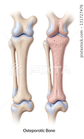 Healthy vs Osteoporotic Bone Microstructure Healthy vs Osteoporotic Bone Microstructure 131727476