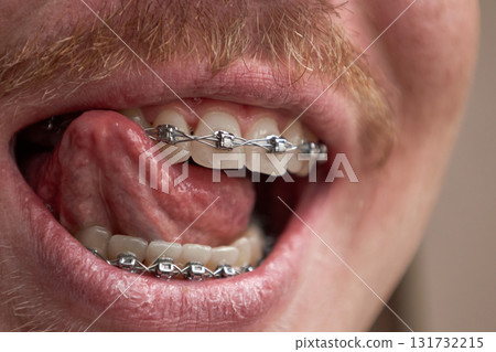 Man licking teeth with orthodontic brackets. Dental braces treatment. Man licking teeth with orthodontic brackets. Dental braces treatment. 131732215