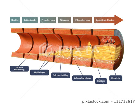 Coronary atherosclerosis timeline 131732617