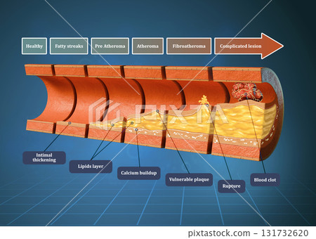 Coronary atherosclerosis timeline Coronary atherosclerosis timeline 131732620