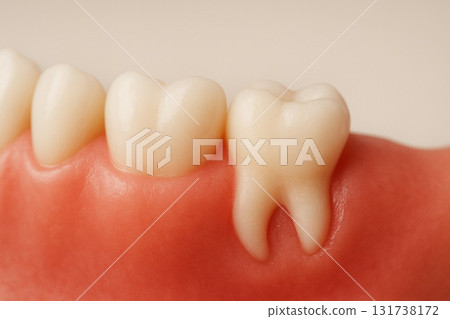 拔除智齒牙科治療 拔除智齒牙科治療 131738172