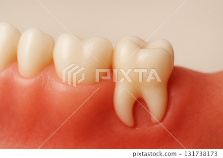 拔除智齒牙科治療 拔除智齒牙科治療 131738173