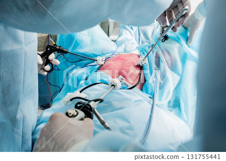Process of gynecological surgery operation using laparoscopic equipment.  131755441