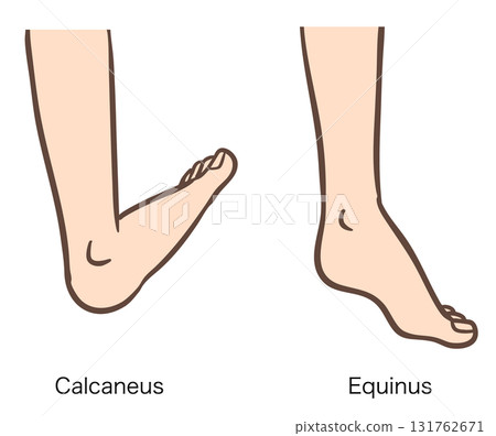 Ankle deformities, heel and equinus Ankle deformities, heel and equinus 131762671