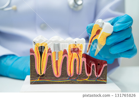 Dentist holding dental implant, artificial tooth roots into jaw, root canal of dental treatment, gum disease, teeth model for dentist. 131765826