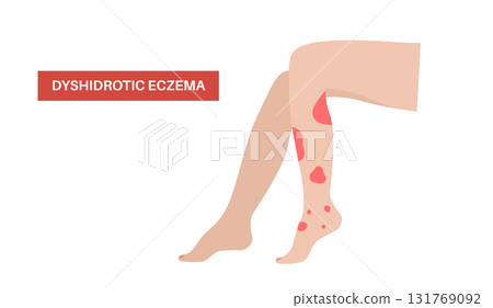 Dermatitis skin disease 131769092