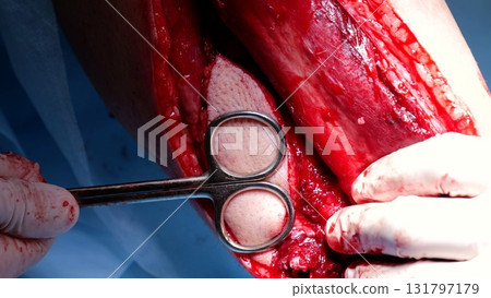 Surgical team performing intricate procedure, carefully handling precision instruments during critical medical intervention saving patient's life Surgical team performing intricate procedure, carefully handling precision instruments during critical medical intervention saving patient's life 131797179