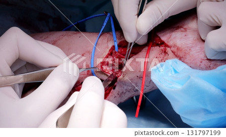 Surgical team performing delicate leg operation, displaying professional expertise and concentrated teamwork in sterile operating room environment Surgical team performing delicate leg operation, displaying professional expertise and concentrated teamwork in sterile operating room environment 131797199