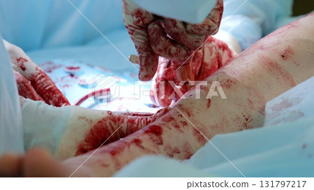 Surgical team performing precise medical intervention, concentrating intently while saving patient's life in sterile operating room environment 131797217