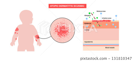 Dermatitis skin disease 131810347