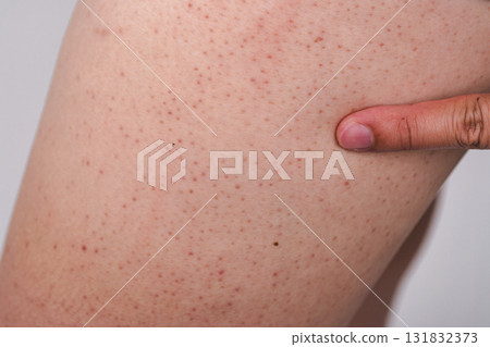 Skin health examination dermatologist consultation clinic medical image professional environment close-up view 131832373