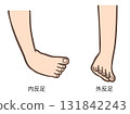 足部畸形、馬蹄足和外翻足插圖 01 131842243
