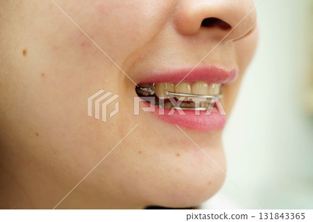 Asian woman with dental braces orthodontic treatment dental care. 131843365