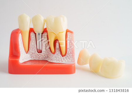 Dental implant, artificial tooth roots into jaw. 131843816