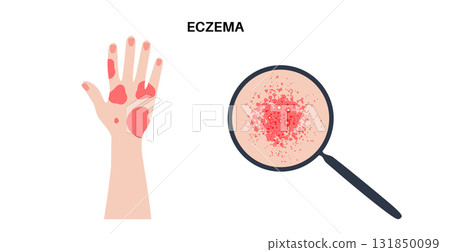 Dermatitis skin disease Dermatitis skin disease 131850099