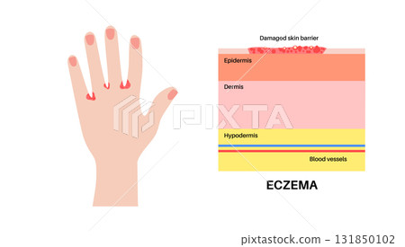 Dermatitis skin disease 131850102