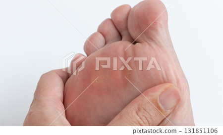 Close-up of a hand gently pressing on a foot with corns and calluses, highlighting foot health and care in a clean, bright environment Close-up of a hand gently pressing on a foot with corns and calluses, highlighting foot health and care in a clean, bright environment 131851106