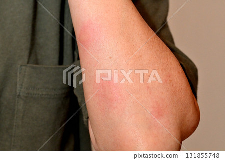 手臂被蚊子咬了 131855748