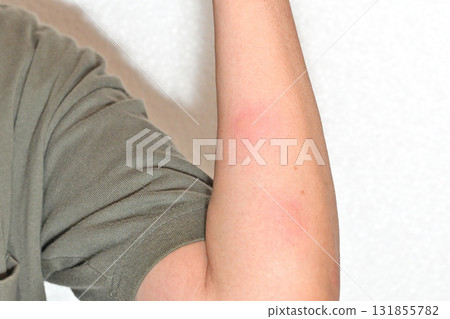 Mosquito bites on arm Mosquito bites on arm 131855782