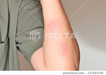Mosquito bites on arm Mosquito bites on arm 131855785