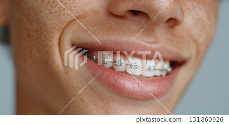 Close up of a smiling teenager showcasing metal dental braces on upper teeth 131860926