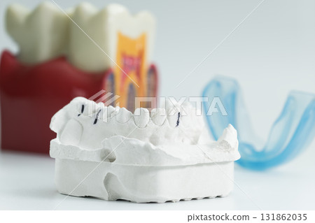 Dental plaster model with mouthguard and tooth anatomy 131862035
