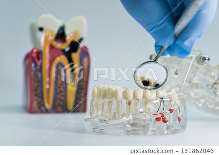 Tooth decay model with dental mirror inspection 131862046