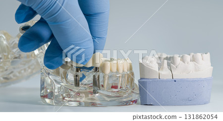 Placing dental implant bridge on transparent jaw model Placing dental implant bridge on transparent jaw model 131862054