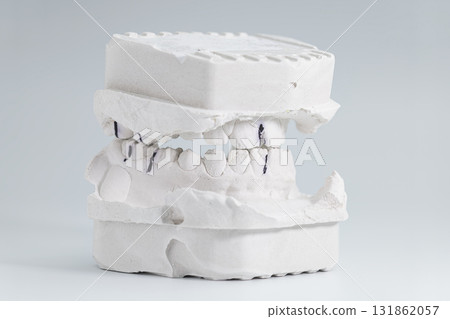 Orthodontic dental cast with bite alignment marks 131862057