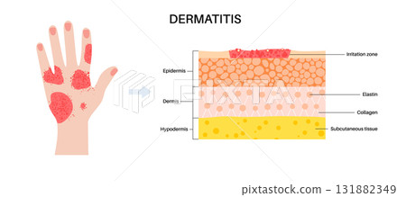Dermatitis skin disease 131882349