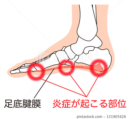 Plantar fascia, plantar aponeurosis, plantar fasciitis, foot muscles 131905826