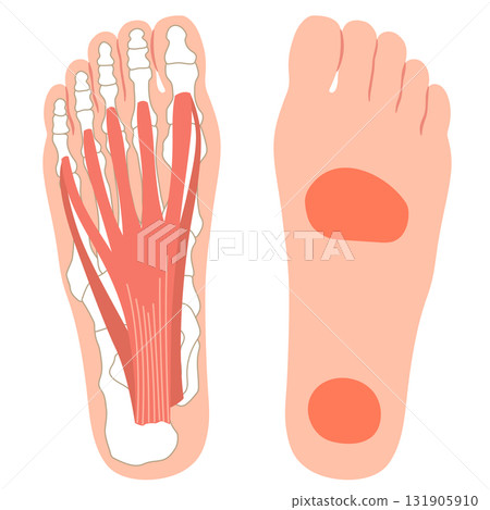 Plantar fasciitis - Painful areas - Plantar fascia - Plantar aponeurosis 131905910