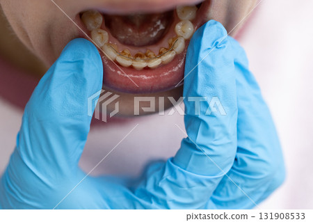 Dentist examining teeth with dental calculus and plaque where also fixed a retainer. Closeup. 131908533