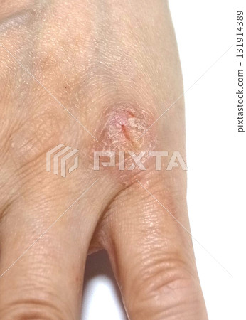 Skin diseases of the hands Skin diseases of the hands 131914389