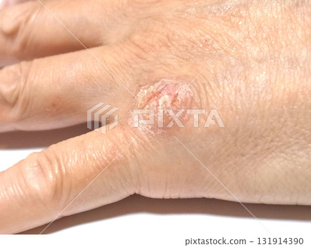 手部皮膚疾病 手部皮膚疾病 131914390
