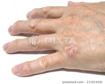 手部皮膚疾病 手部皮膚疾病 131914392