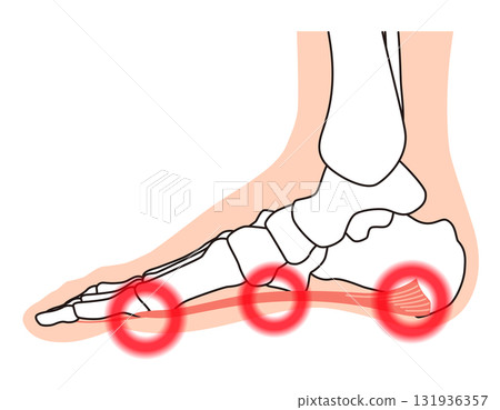 Plantar fascia, plantar aponeurosis, plantar fasciitis, foot muscles 131936357