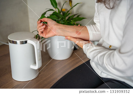 Scald burn on a hand caused by steam from a kettle in a kitchen. Domestic accident illustrating the danger of hot appliances. 131939352