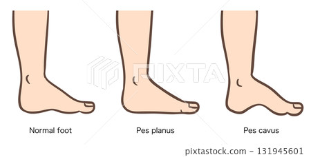 Foot deformity, normal foot, flat foot, cavus foot illustration set 02 131945601